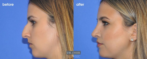 drdhir-rhinoplasty-nose-35-5