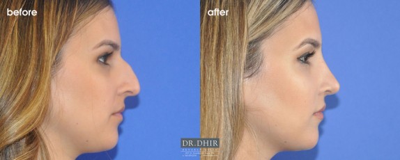 drdhir-rhinoplasty-nose-35-3