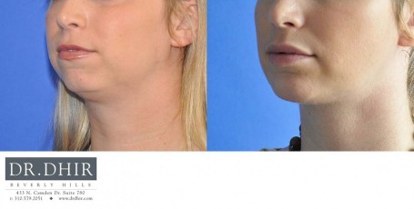 drdhir-facial-implant-5-4