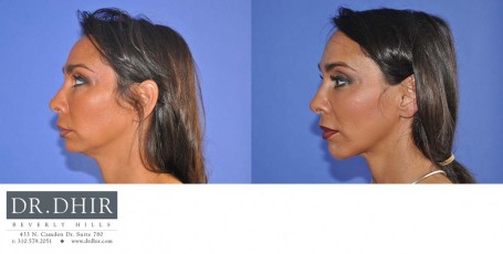 drdhir-facial-implant-6-5